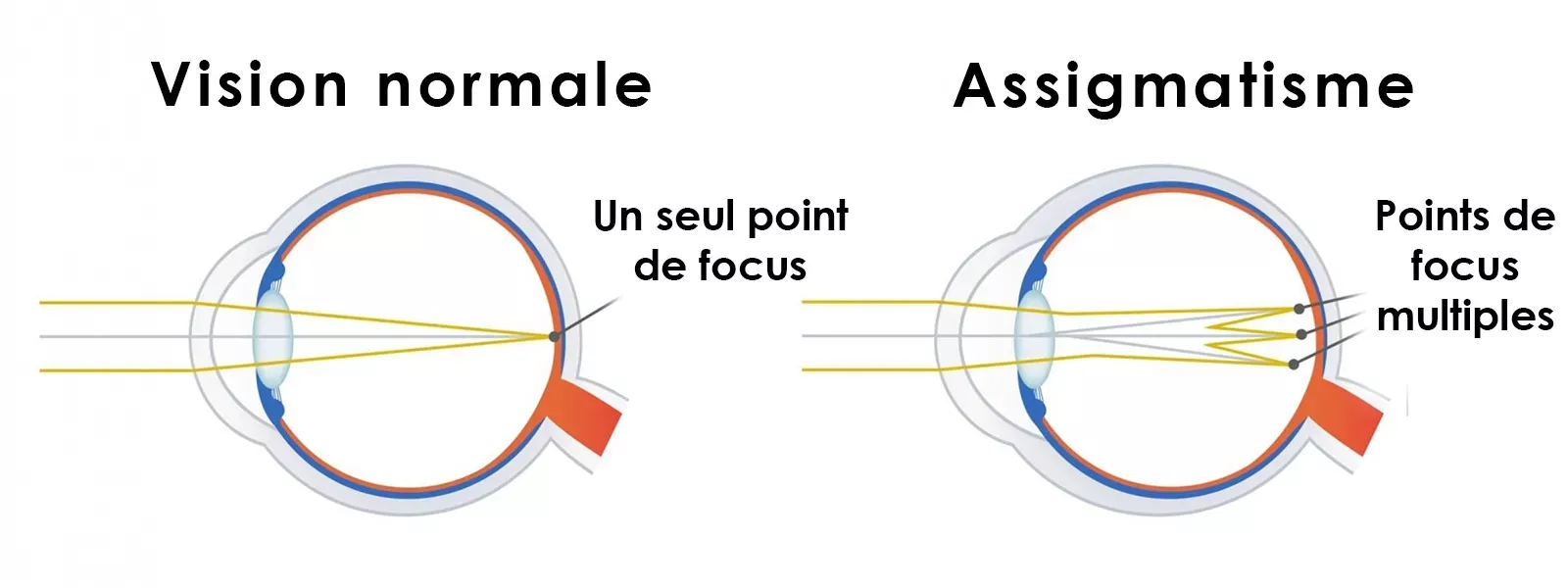 Qu'est-ce que l'astigmatisme ?